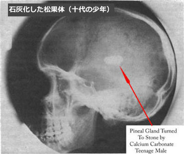 pineal-gland-calcification.jpg